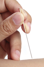 Punción Seca en Clínica Arenal